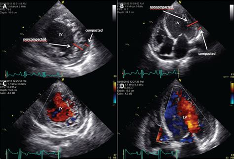 non compaction cardiomyopathy echo criteria